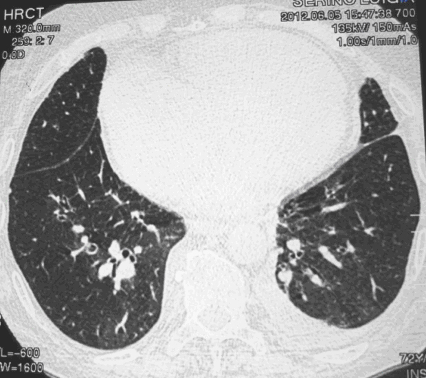 Tac Ispessimento Delle Pareti Bronchiali